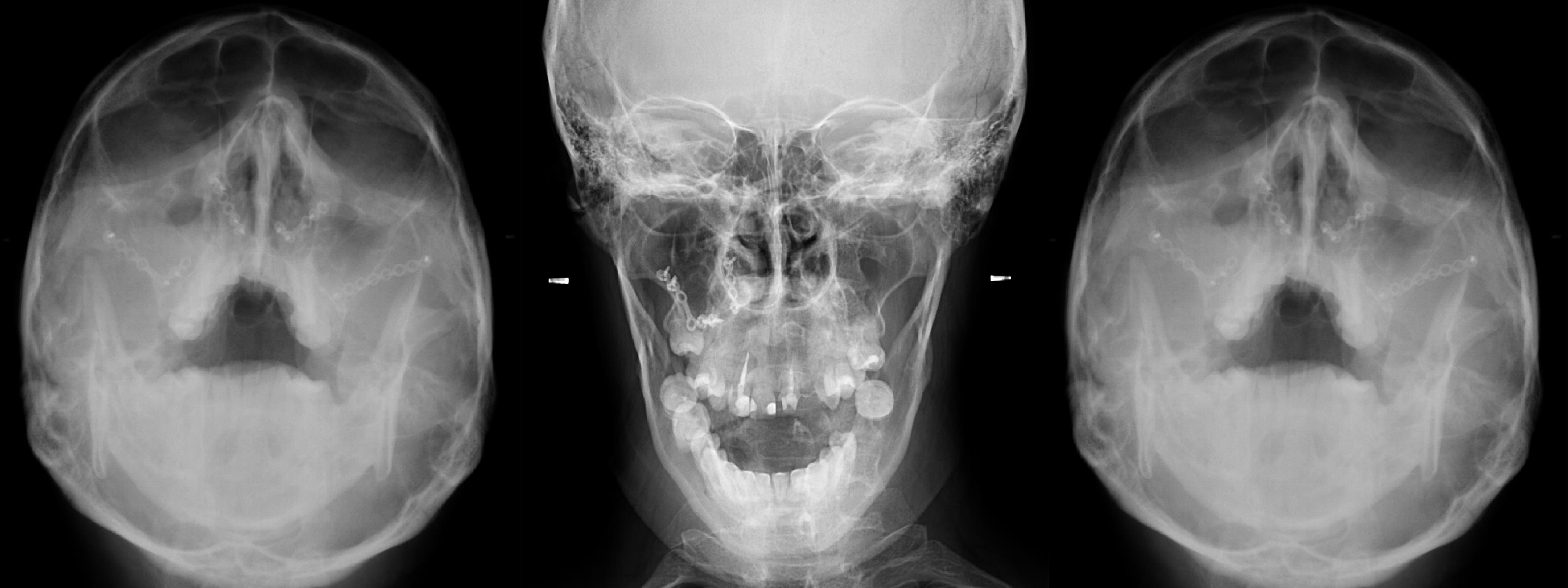 Radiografía Intrabucal